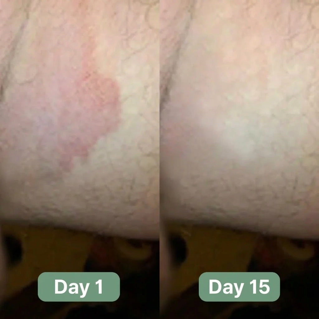 Seravon AntiFungal Bar™