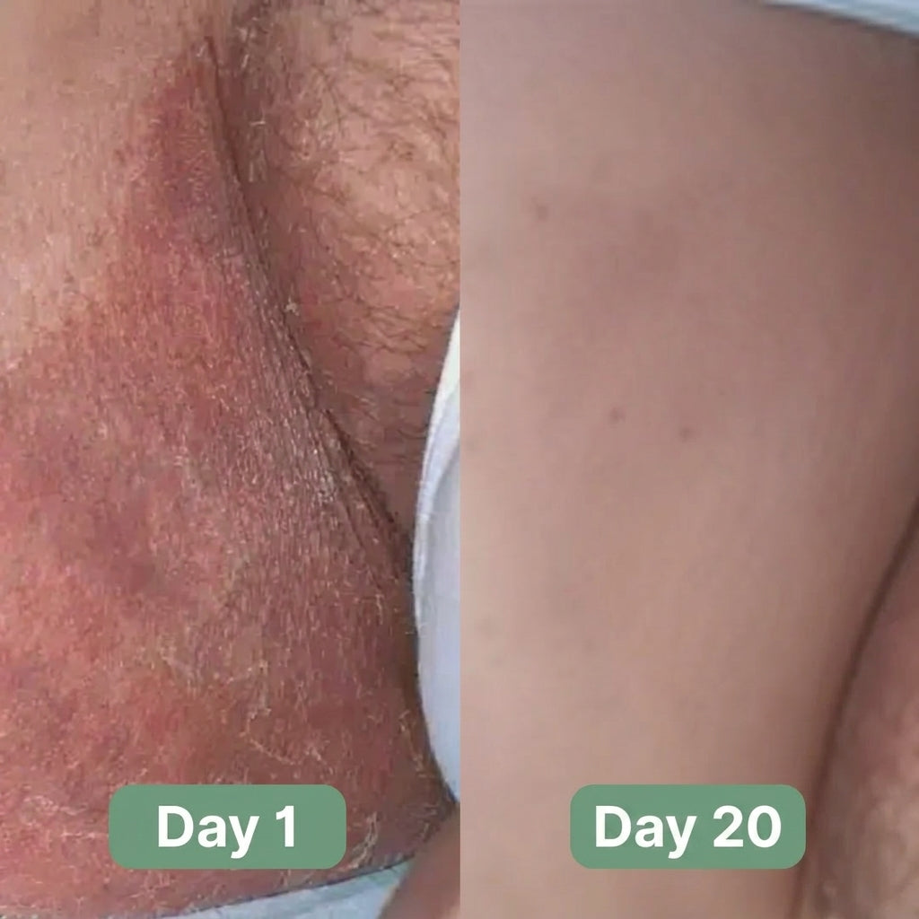 Seravon AntiFungal Bar™